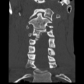 Normal trauma cervical spine (Radiopaedia 41017-43760 Coronal bone window 17).png