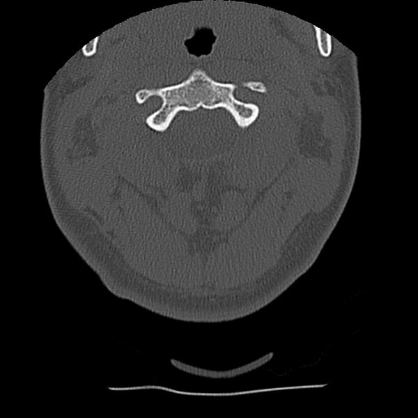 File:Normal trauma spine imaging (Radiopaedia 31753-32686 Axial bone window 18).jpg