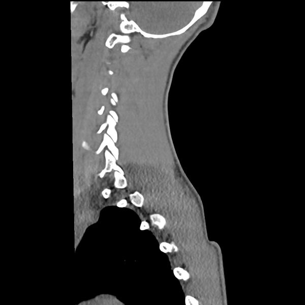 File:Normal trauma spine imaging (age 16) (Radiopaedia 45335-49358 C 33).jpg