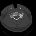 Occipital condyle fracture (Radiopaedia 31755-32691 Axial bone window 48).jpg
