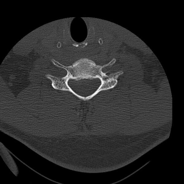 File:Occipital condyle fracture (Radiopaedia 31755-32691 Axial bone window 56).jpg