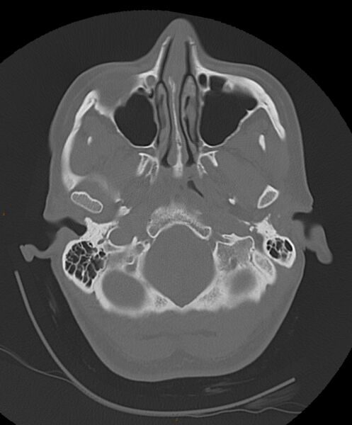 File:Occipital condyle fracture (Radiopaedia 61165-69056 Axial bone window 21).jpg