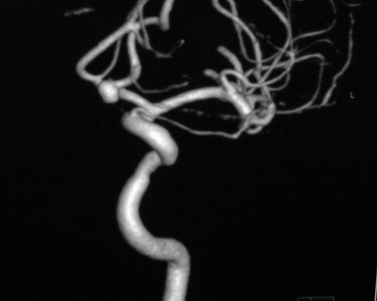 File:ACOM aneursym (Radiopaedia 4805-6783 Internal carotid artery 1).jpg