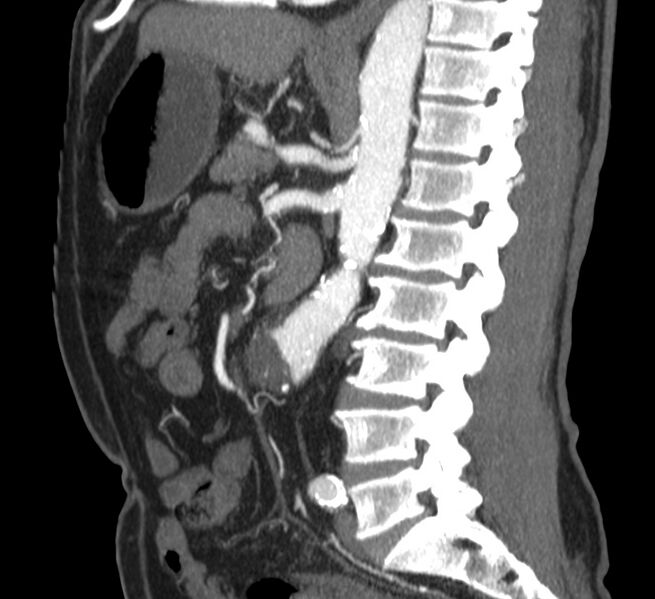 File:Abdominal aortic aneurysm (Radiopaedia 22421-22458 D 23).jpg