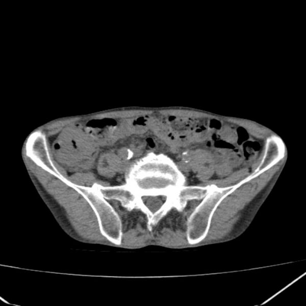File:Abdominal aortic aneurysm (Radiopaedia 23703-23856 Axial non-contrast 40).jpg