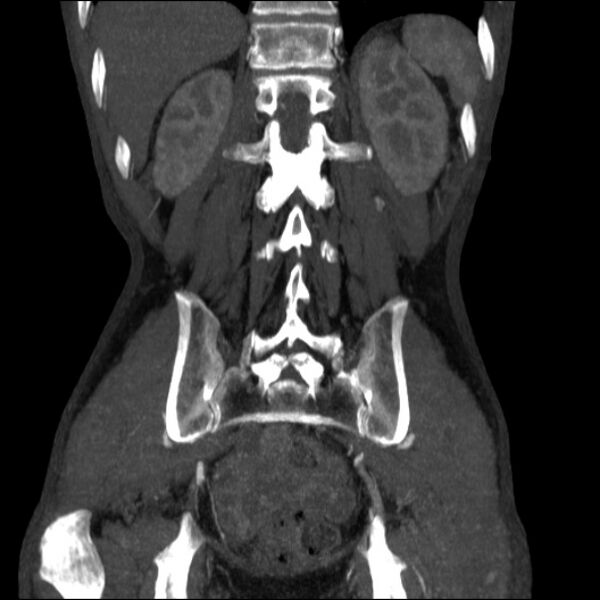 File:Abdominal aortic aneurysm (Radiopaedia 23703-23856 Coronal C+ arterial phase 28).jpg