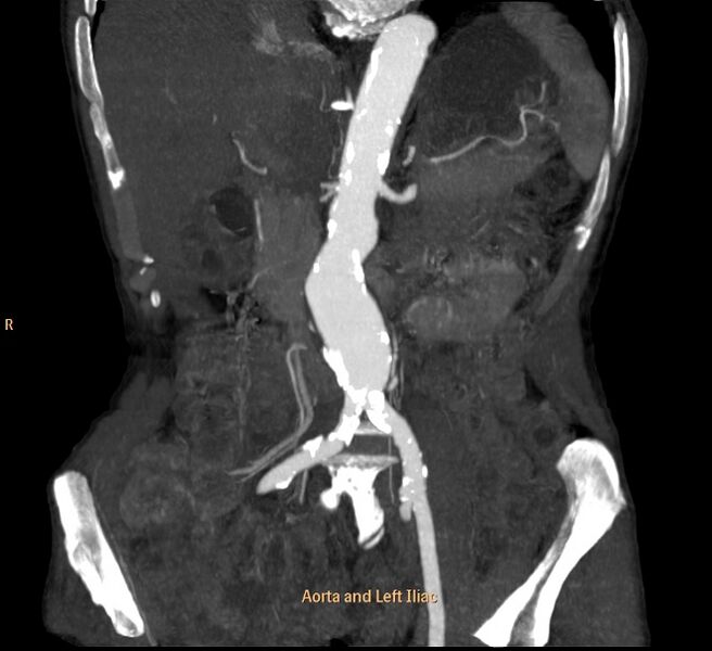 File:Abdominal aortic aneurysm (Radiopaedia 23703-23856 F 1).jpg