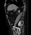 Abdominal aortic aneurysm (Radiopaedia 25855-26001 Sagittal C+ arterial phase 4).jpg