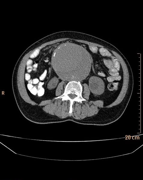 File:Abdominal aortic aneurysm (Radiopaedia 25985-26121 Axial non-contrast 14).jpg
