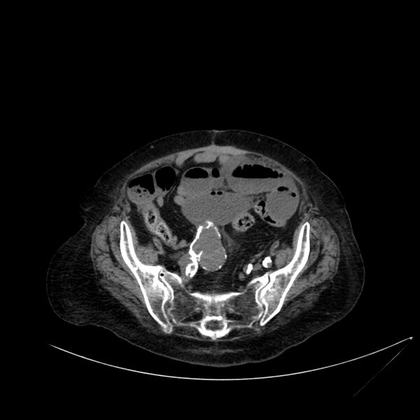 File:Abdominal aortic aneurysm - impending rupture (Radiopaedia 19233-19246 Axial non-contrast 97).jpg