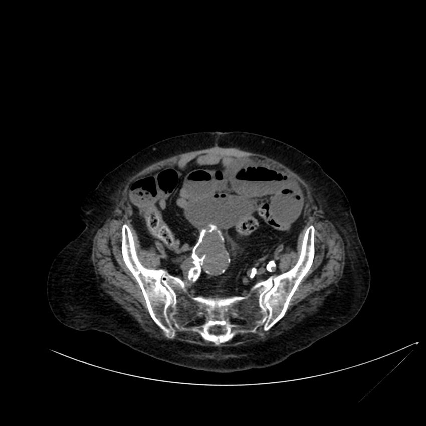Abdominal aortic aneurysm - impending rupture (Radiopaedia 19233-19246 Axial non-contrast 97).jpg