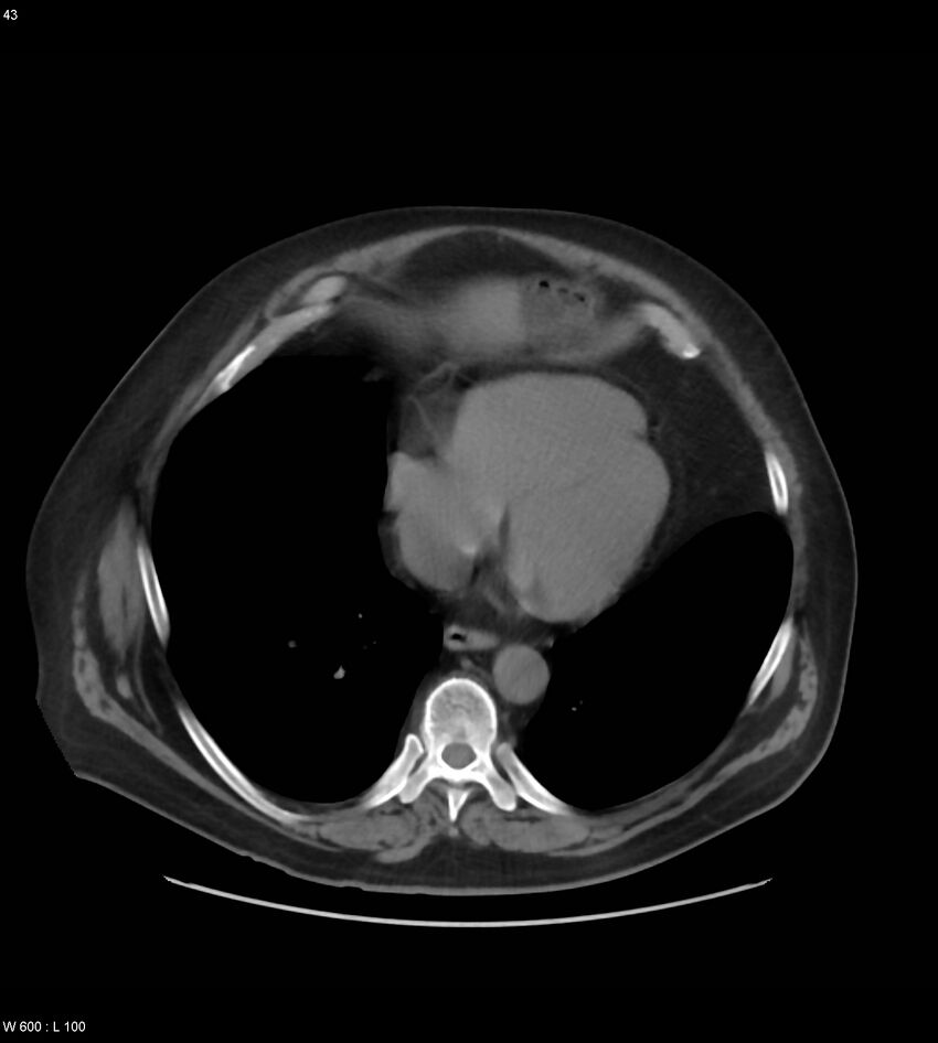 Abdominal aortic aneurysm with intramural hematoma then rupture (Radiopaedia 50278-55631 Axial non-contrast 39).jpg