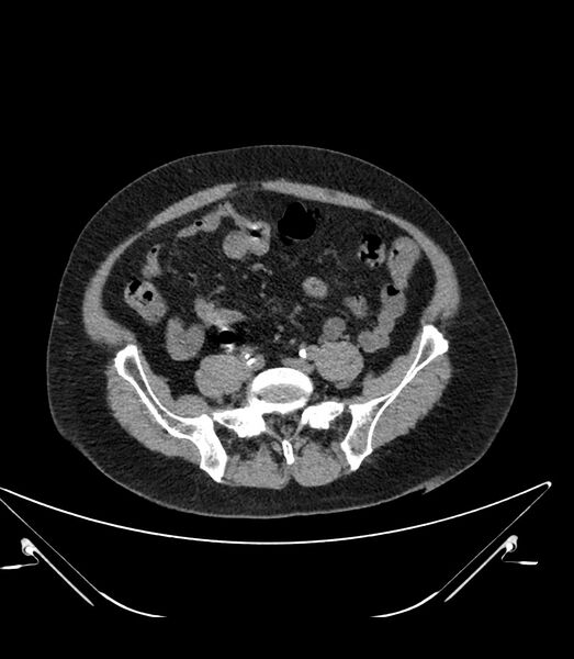 File:Abdominal aortic aneurysm with thrombus fissuration (Radiopaedia 46218-50618 Axial non-contrast 39).jpg