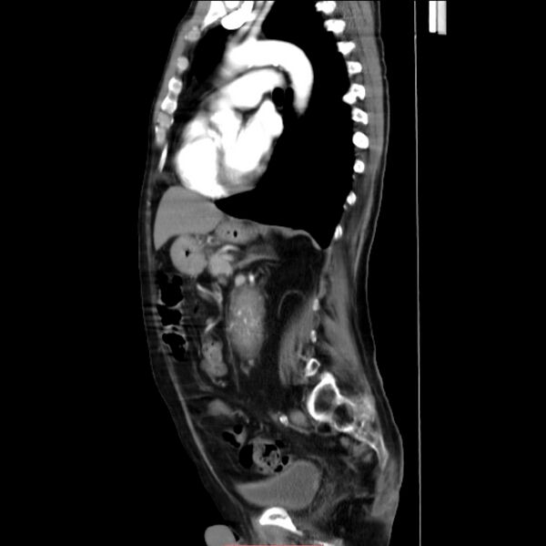 File:Abdominal aortic interposition tube graft and aneurysm thrombosis (Radiopaedia 71438-81857 Sagittal C+ arterial phase 12).jpg