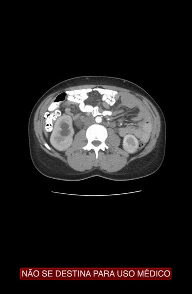 File:Abdominal desmoid tumor (Radiopaedia 44024-47540 Axial C+ arterial phase 12).jpg