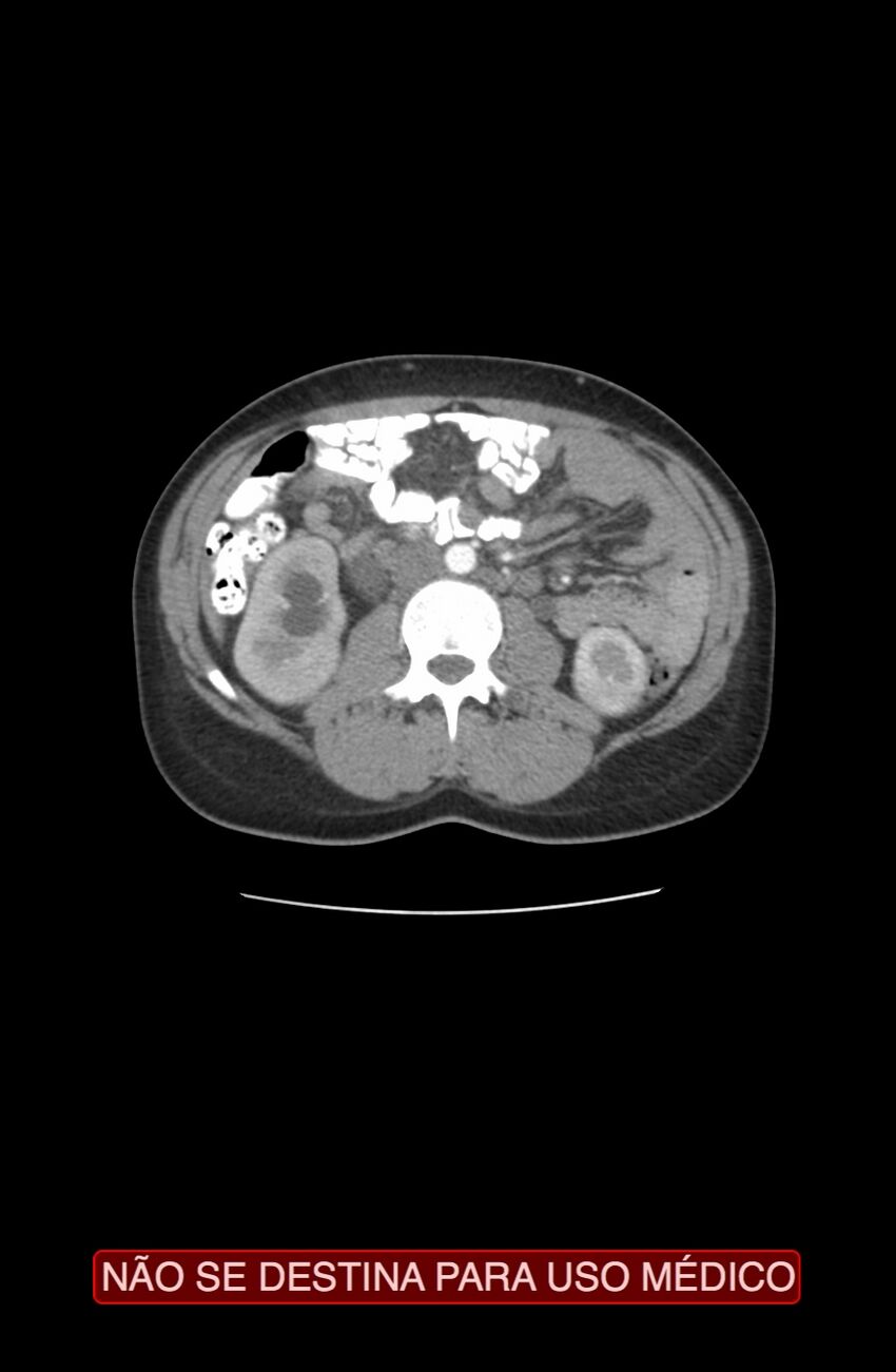 Abdominal desmoid tumor (Radiopaedia 44024-47540 Axial C+ arterial phase 12).jpg