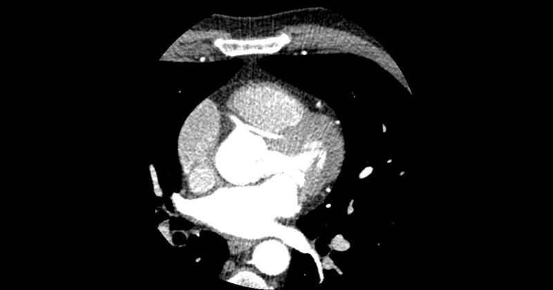 File:Aberrant left main coronary artery (ALMCA) arising from the right sinus with interarterial course (Radiopaedia 63251-71814 Axial C+ arterial phase 74).JPG