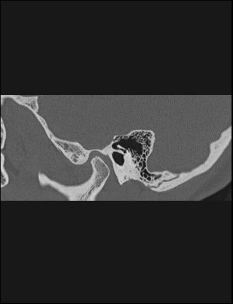 File:Aberrant right internal carotid artery (Radiopaedia 65191-74198 Sagittal non-contrast 38).jpg