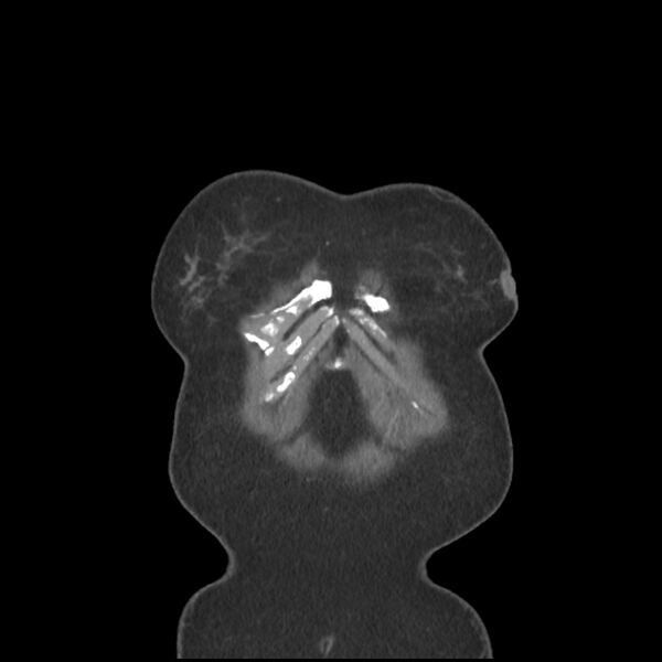File:Aberrant right subclavian and left vertebral arteries (Radiopaedia 43467-46847 Coronal C+ portal venous phase 3).jpg