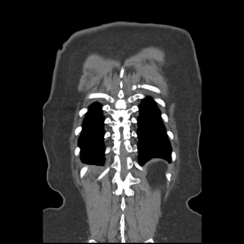 Aberrant right subclavian and left vertebral arteries (Radiopaedia 43467-46847 Coronal C+ portal venous phase 78).jpg