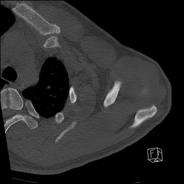File:Acromioclavicular joint dissociation - type IV (Radiopaedia 64411-73216 Axial bone window 15).jpg