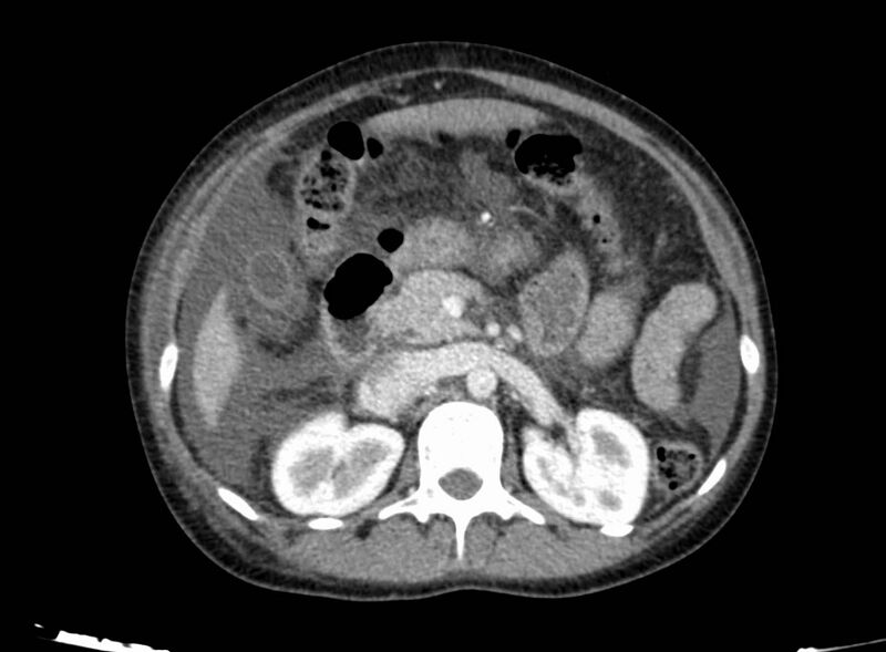 File:Acute Budd-Chiari syndrome (Radiopaedia 60858-68638 Axial C+ portal venous phase 118).jpg