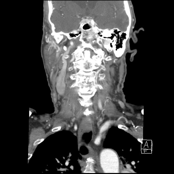 File:Acute ICA ischemic penumbra due to high-grade CCA stenosis (CT perfusion) (Radiopaedia 72038-82530 Coronal C+ arterial phase 23).jpg
