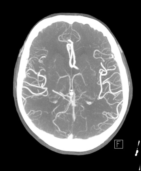 File:Acute P1 occlusion with PCA ischemia penumbra (CT perfusion) (Radiopaedia 72084-82587 Axial C+ arterial thick MIP 6).jpg