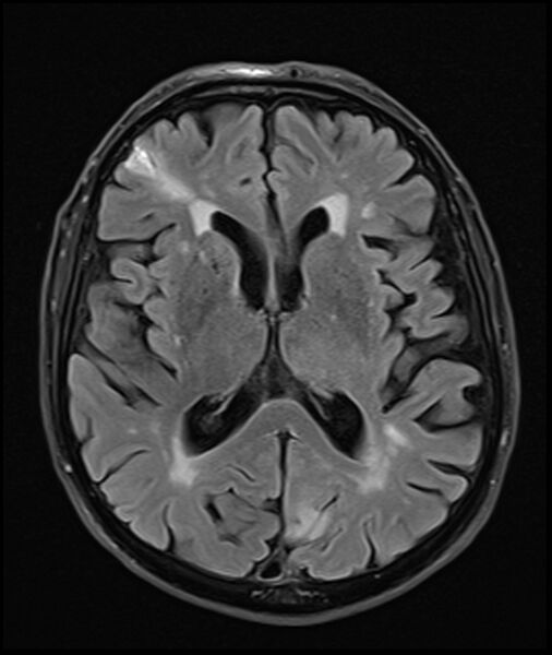 File:Acute P1 occlusion with PCA ischemia penumbra (CT perfusion) (Radiopaedia 72084-82590 Axial FLAIR 20).jpg