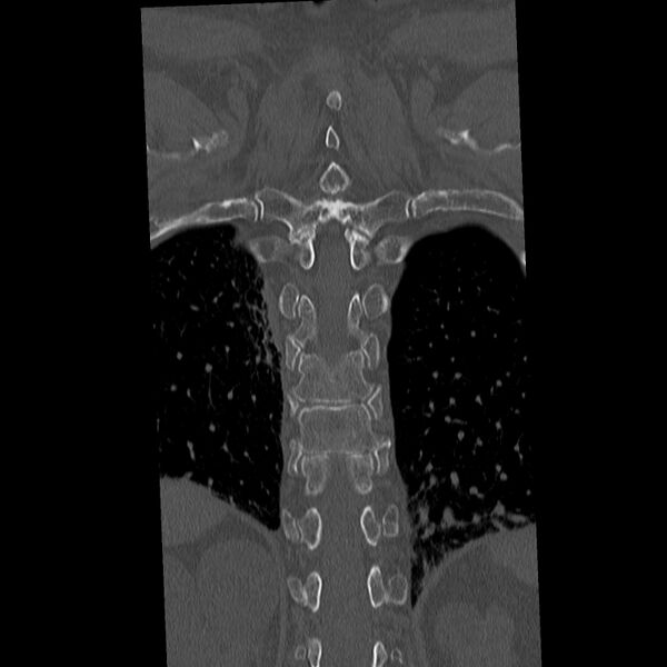 File:Acute and chronic vertebral compression fractures (Radiopaedia 31608-32494 Coronal bone window 34).jpg