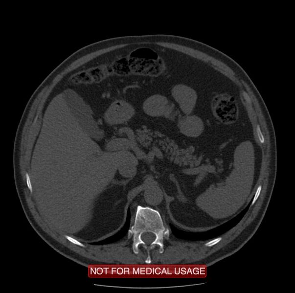 File:Acute aortic dissection - Stanford type A (Radiopaedia 40661-43285 Axial non-contrast 84).jpg