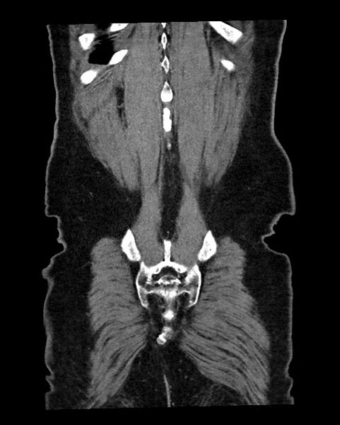 File:Acute appendicitis - large appendicoliths (Radiopaedia 61805-69820 Coronal C+ portal venous phase 121).jpg
