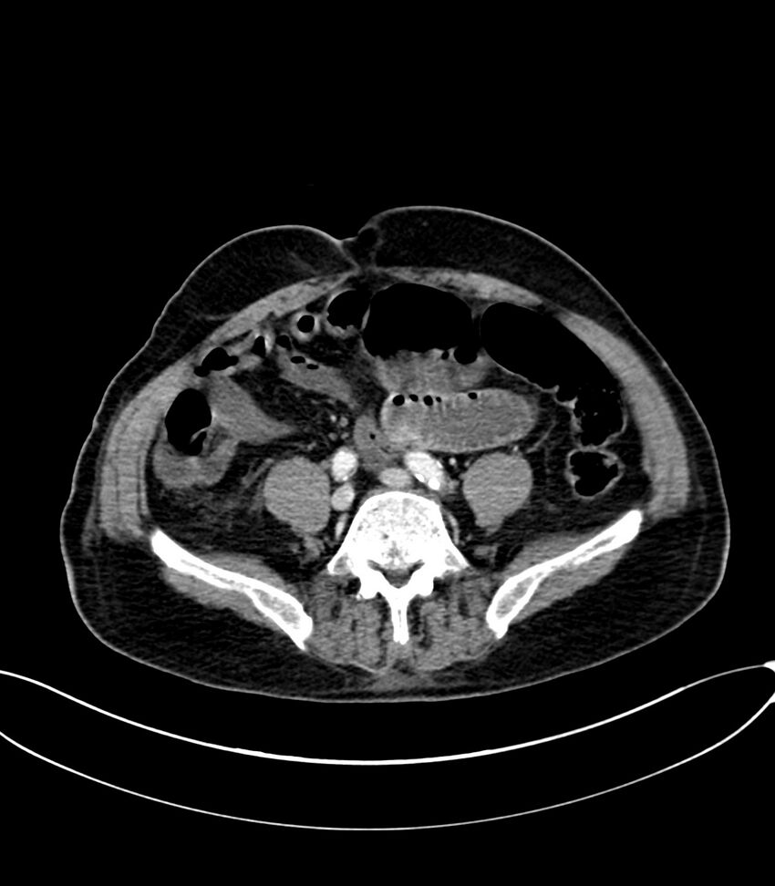 Acute arterial mesenteric ischemia (Radiopaedia 78238-90828 Axial C+ portal venous phase 96).jpg