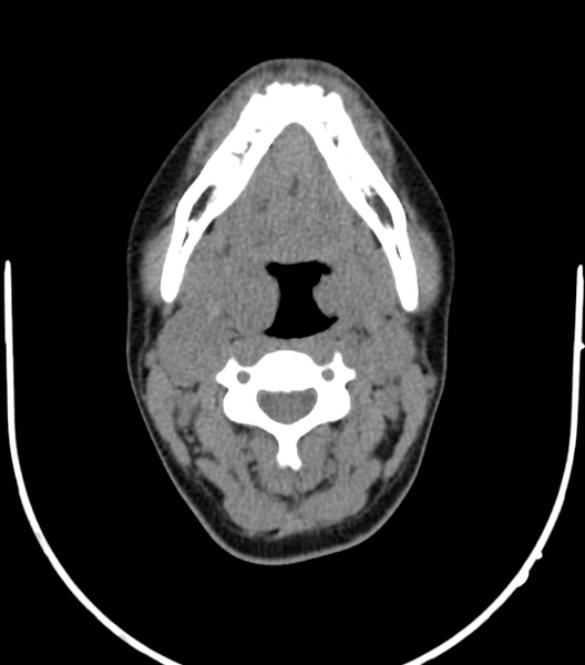 File:Acute bacterial tonsillitis (Radiopaedia 22882-22908 Axial non-contrast 24).png
