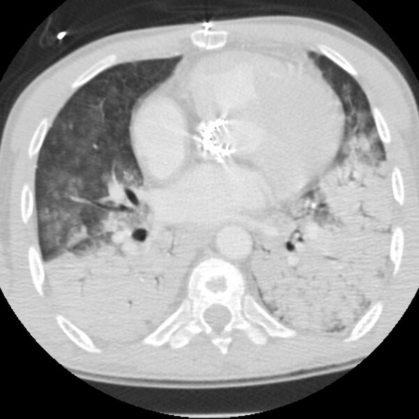File:Acute diffuse alveolar hemorrhage (Radiopaedia 41323-44158 Axial lung window 35).jpg