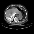 Acute heart failure (CT) (Radiopaedia 79835-93075 Axial C+ arterial phase 66).jpg