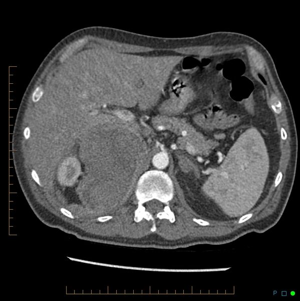 File:Acute hemorrhage into adrenal metastasis from NSCLC (Radiopaedia 43135-46429 Axial C+ arterial phase 7).jpg