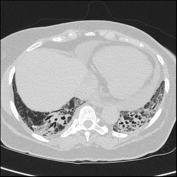 File:Acute interstitial pneumonitis (Radiopaedia 45404-49453 Axial lung window 61).jpg