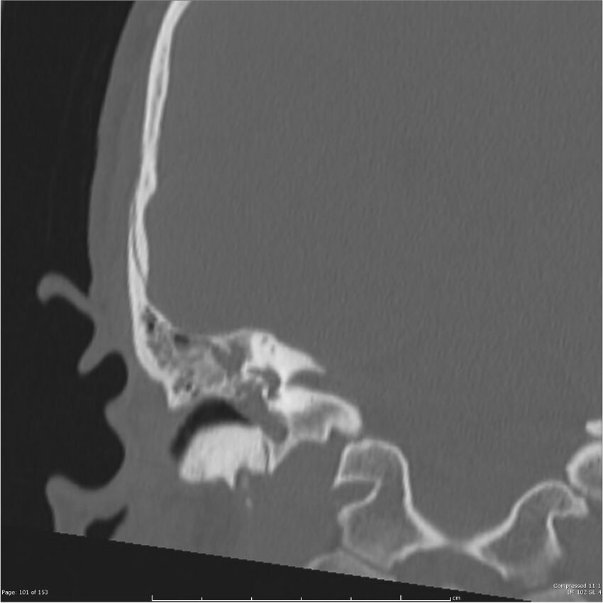 Acute otomastoiditis (Radiopaedia 28276-28512 Coronal PTB bone window reformat 32).jpg
