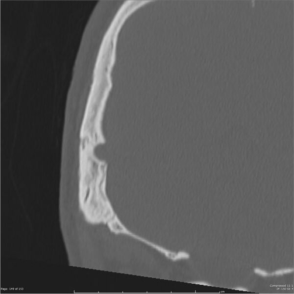 File:Acute otomastoiditis (Radiopaedia 28276-28512 Coronal PTB bone window reformat 80).jpg