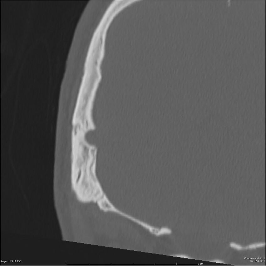 Acute otomastoiditis (Radiopaedia 28276-28512 Coronal PTB bone window reformat 80).jpg