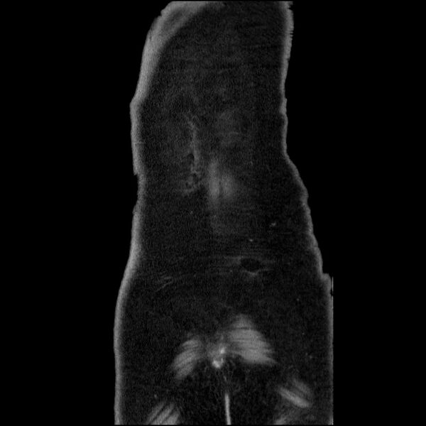 File:Acute pancreatitis (Radiopaedia 69236-79012 Coronal C+ portal venous phase 12).jpg