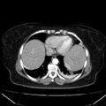 Acute pancreatitis - Balthazar C (Radiopaedia 26569-26714 Axial C+ arterial phase 8).jpg
