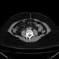 Acute pancreatitis - Balthazar C (Radiopaedia 26569-26714 Axial non-contrast 58).jpg