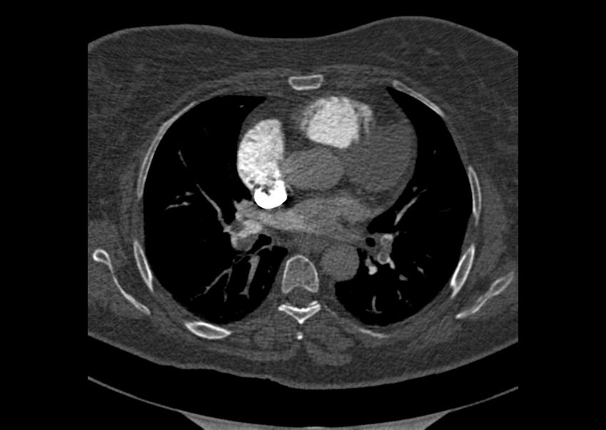 Acute pulmonary embolism (Radiopaedia 29938-30466 Axial C+ CTPA 92).jpg