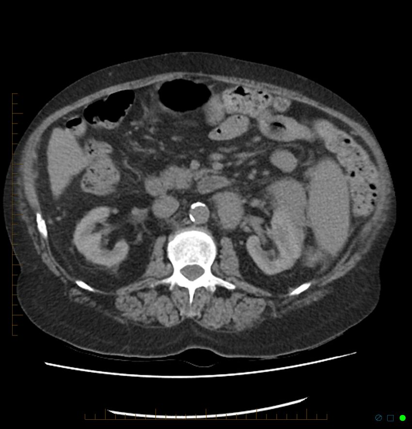 Acute renal failure post IV contrast injection- CT findings (Radiopaedia 47815-52557 Axial non-contrast 34).jpg