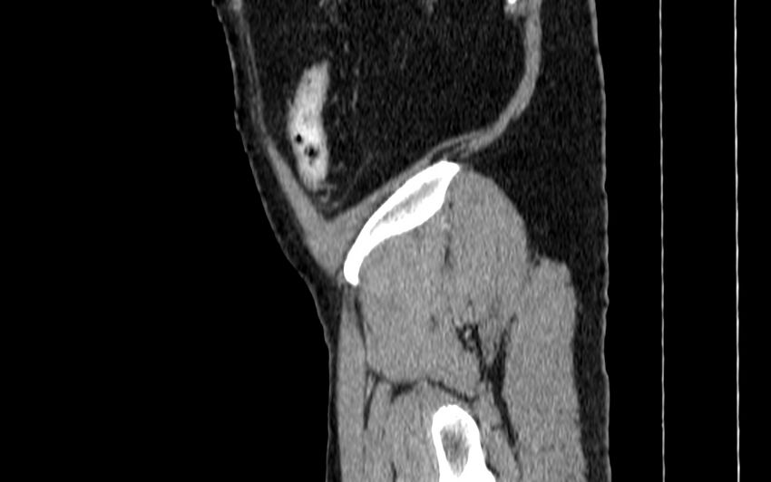Acute sigmoid colon diverticulitis (Radiopaedia 55507-61976 Sagittal C+ portal venous phase 134).jpg