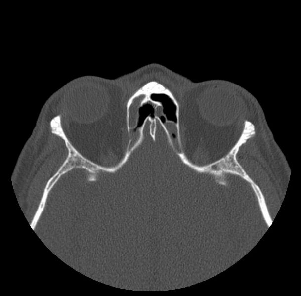 File:Acute sinusitis (Radiopaedia 23161-23215 Axial bone window 55).jpg