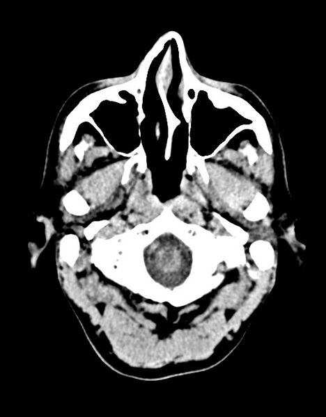 File:Acute superior cerebellar artery territory infarct (Radiopaedia 84104-99359 Axial non-contrast 61).jpg