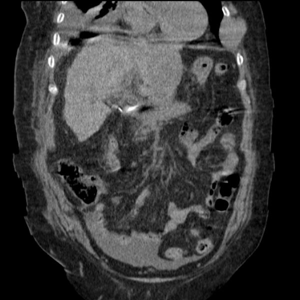 File:Acute tubular necrosis (Radiopaedia 28077-28334 G 33).jpg